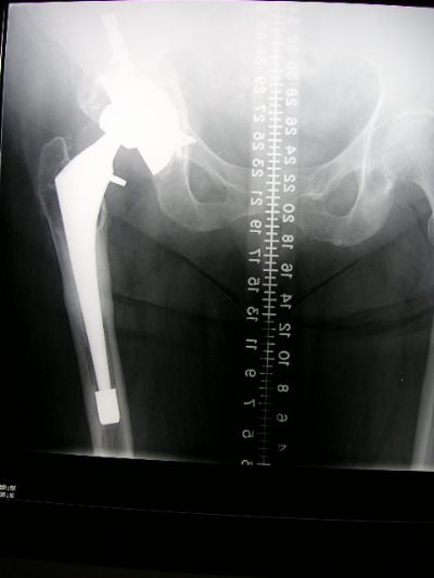 Osteonics Omniflex & PSL Cup (Implant 411)